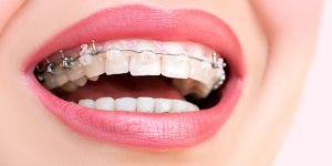 ¿Duelen los tratamientos de Ortodoncia?