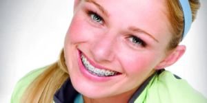 Problemas de llagas en la ortodoncia